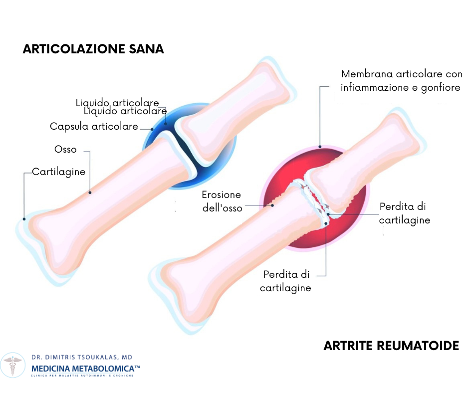 articolazioni artrite