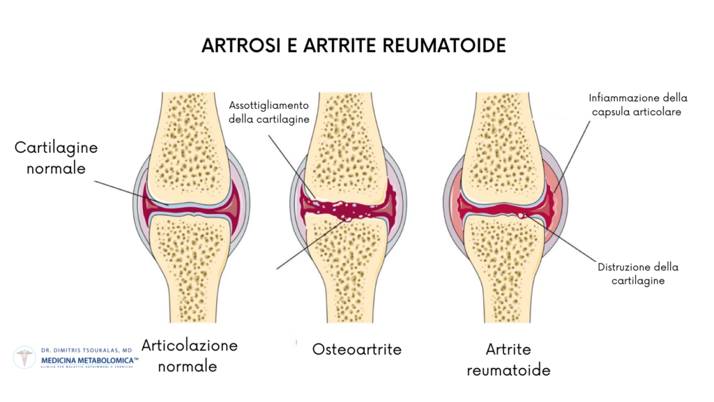 osteoartrite