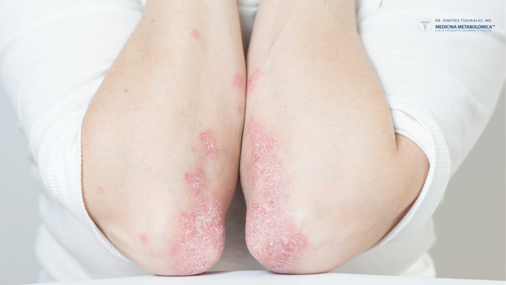 psoriasi malattia autoimmune