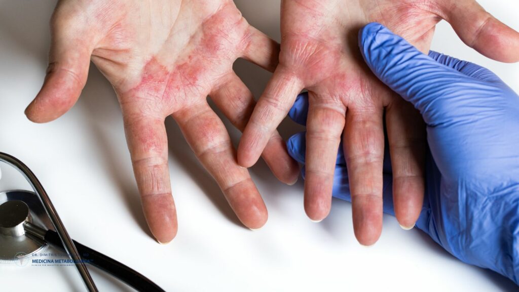 dermatite atopica